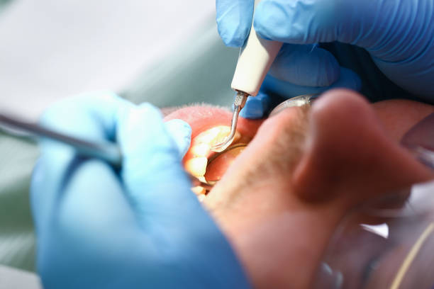 Best Emergency Dental Care for Broken or Chipped Teeth in Old Brookville, NY