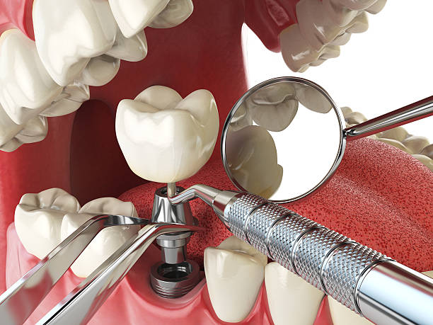 Best Emergency Tooth Extraction in Old Brookville, NY